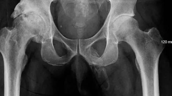 음경 전체가 뼈처럼 굳고 있는 남성의 사례가 보고됐다. (사진=뉴욕포스트) *재판매 및 DB 금지 /사진=뉴시스