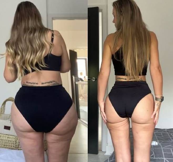 영국의 한 30대 여성이 BBL 수술을 받은 뒤 부작용을 겪은 후 이전 몸매로 돌아가기 위해 체중을 감량한 사연이 공개됐다. 왼쪽은 성형수술을 받은 이후, 오른쪽은 이후 살을 뺀 사진이다./사진=더 선
