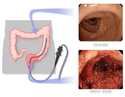 정상 대장(위)과 궤양성 대장염(아래)의 대장 내시경 검사 소견. /사진=질병관리청 국가건강정보포털.