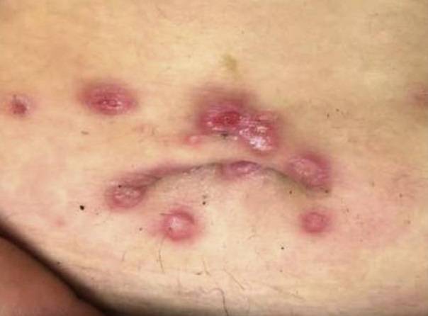 배꼽 주변에 나타난 편평 콘딜로마./사진=JAAD Case Reports