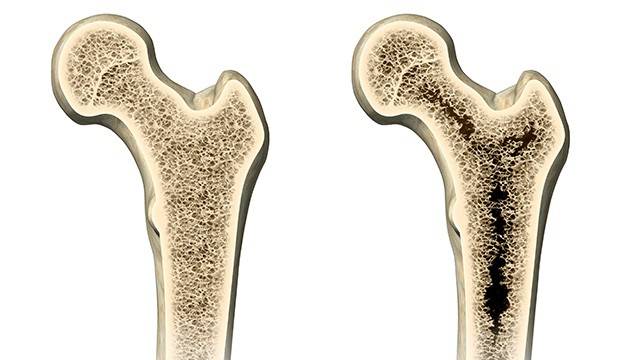 골다공증은 초기에 뚜렷한 증상이 없어 '소리 없는 질병'으로 불린다|출처: 클립아트코리아