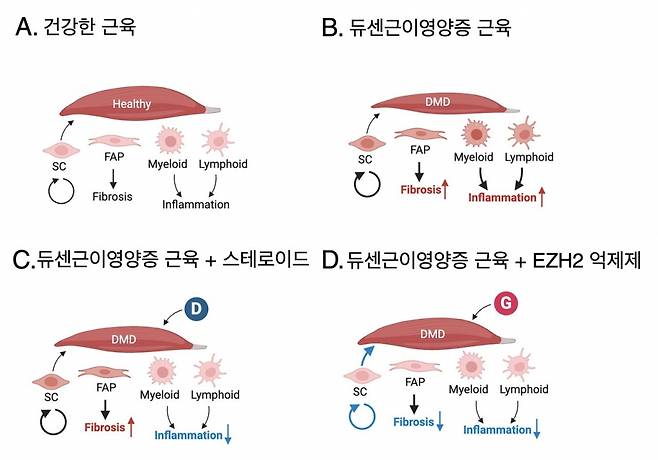DMD 동물모델에서 스테로이드와 EZH2 억제제의 근육 재생, 섬유화 및 염증 반응에 대한 효과 비교: (A) 건강한 근육? 정상적인 근육 구조 유지, 염증과 섬유화 없음. (B) 듀센근이영양증 근육? 근육 손상, 염증과 섬유화 증가. (C) 듀센근이영양증 + 스테로이드? 염증은 감소하지만 섬유화 지속. (D) 듀센근이영양증 + EZH2 억제제? 염증과 섬유화 동시 감소, 근육 재생 촉진. /그림=서울대병원