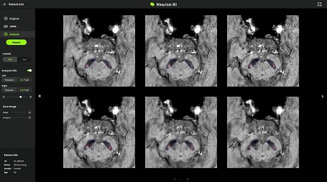 휴런 파킨슨병 솔루션 '휴런NI'(사진=휴런)