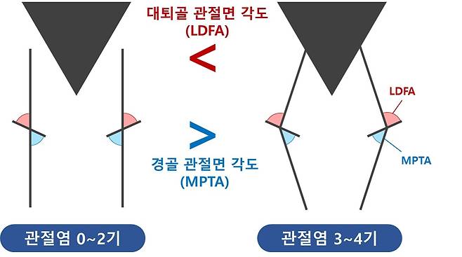 관절염 심각도별 선천적인 무릎 변수 차이 관절염 3~4기 환자는 0~2기 대비 대퇴골 관절면 각도(LDFA)가 크고 경골 관절면 각도(MPTA)가 작아, 내반 정렬의 특성이 뚜렷했다.