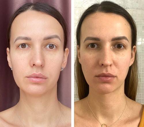 구글에서 검색되는 외국 업체의 비대칭 교정 홍보 사진입니다. 사실, 국내의 홍보사진들도 그 수준은 대동소이합니다.