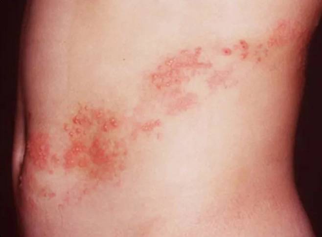 몸통 부위에 띠 모양으로 발생한 대상포진. 빠른 항바이러스제 투여가 필요하다. 국가건강정보포털 제공