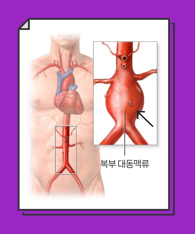 복부 대동맥류는 배 가운데를 지나는 대동맥이 부풀어오르는 질환이다. 점점 부풀다 혈관이 터지면 사망 가능성이 매우 높다. 그래픽 이가진·박지은
