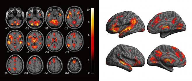 사이버불링이 뇌에 미치는 현실적 고통 - 호주 선샤인코스트대 연구팀이 사이버불링 영상을 본 실험 참가자들의 뇌를 자기공명영상(fMRI) 촬영한 결과, 기억, 감정, 주의력과 관련된 중간 측두회, 전두엽, 시상, 소뇌 등 여러 영역이 활성화되는 것으로 나타났다. 왼쪽은 사이버불링 영상을 보고 활성화된 뇌의 단면들을 오른쪽은 같은 뇌에서 활성화 부위의 표면을 확대한 것이다. 피해자의 뇌가 사이버불링을 실제 고통으로 인식할 가능성을 시사하는 결과다. McLoughlin et al 제공