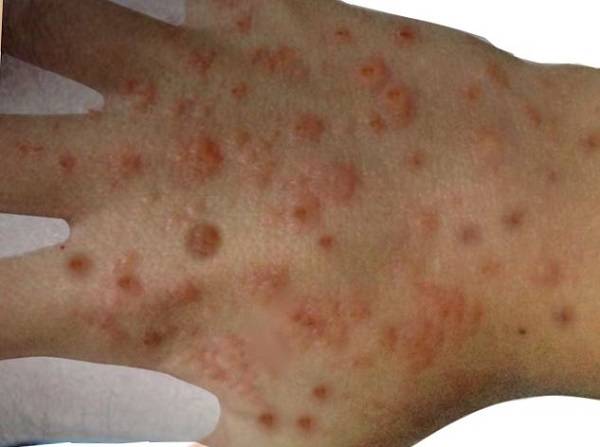 손에 우두모양물집증이 발생한 모습/사진=MD SearchLight