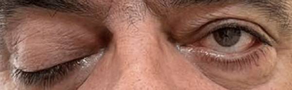 당뇨병성 동안신경 마비로 인해 오른쪽 눈에 심한 안검하수가 나타나고, 양쪽 동공이 바라보는 방향이 달라지는 부작용을 겪는 남성의 눈./사진=큐레우스