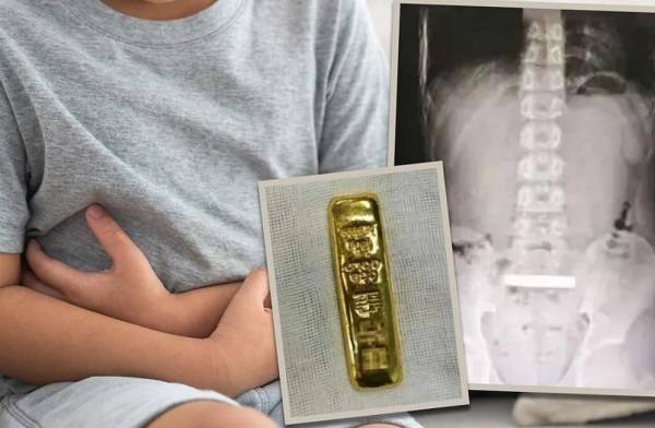 중국의 한 10대 소년이 금괴를 삼켜 제거 수술을 받은 충격적인 사연이 공개됐다./사진=홍콩 사우스차이나모닝포스트