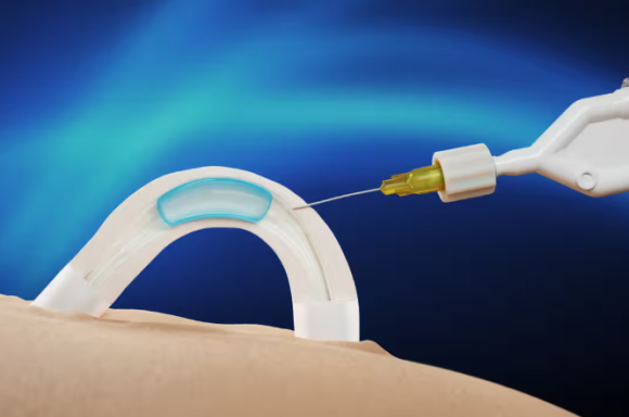 남성 피임 수단으로 사용돼온 콘돔과 정관수술을 대체할 수 있는 새로운 남성 피임법이 등장해 관심이 쏠리고 있다. 해당 피임법은 정관에 하이드로겔을 이식하는 방식으로, 시술 시간은 약 10분이다. 콘트랄린