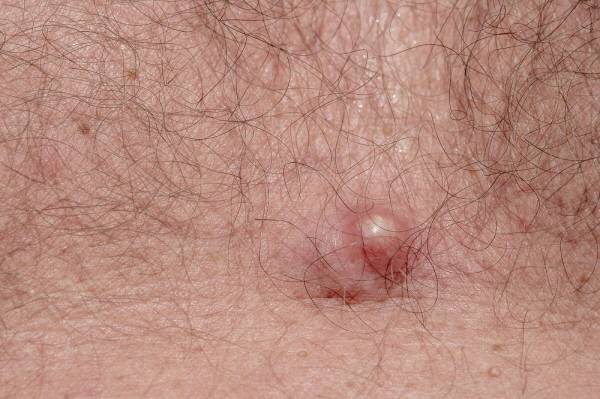 편평세포암/사진=게티이미지뱅크