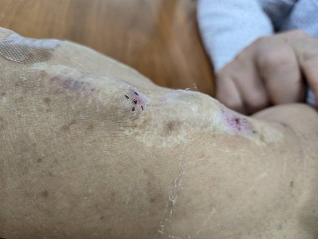 지난 3월 27일 부산 장애인종합회관에서 만난 오성옥(58) 씨의 왼팔. 30년간 신장 투석을 받으며 이틀에 한 번꼴로 굵은 주삿바늘을 꽂은 흔적이다. 상처가 아물기도 전에 살을 파고드는 주사로 성옥 씨 팔은 제 모습을 잃은 지 오래다. 임재환 기자