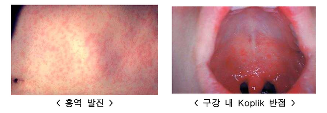 홍역 주요 증상. (사진, 미국질병관리본부, Centers for Disease Control and Prevention)