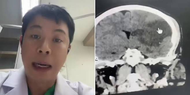 태국의 한 의사가 목 마사지를 받다 불구가 된 50대 남성의 뇌 검사 화면을 보여주고 있다./페이스북