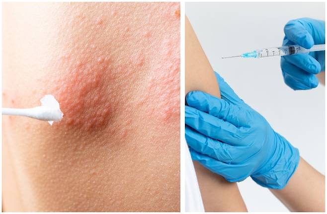 대상포진 백신 접종을 하면 심혈관질환 위험을 23% 낮출 수 있다는 연구결과가 나왔다. 게티이미지뱅크