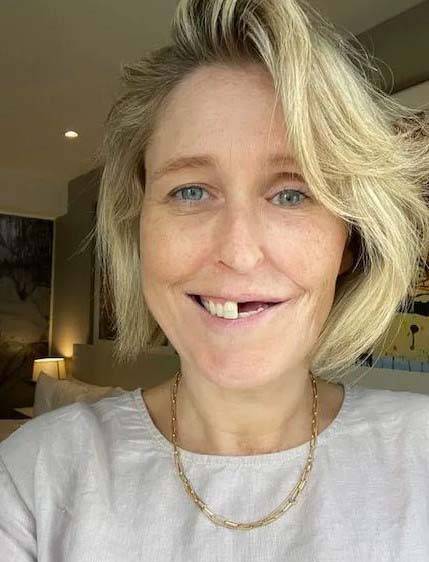 남편과 키스후 두경부암 진단을 받아 반쪽 얼굴이 된 사라 수삭의 모습/사진=더 선