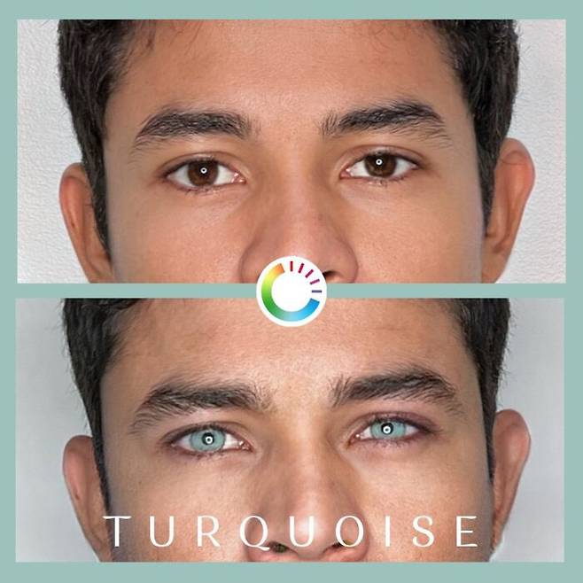 아이링 수술 전후 사진