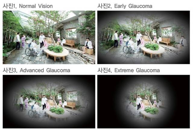 정상(사진1)에서 녹내장이 진행될수록 사진 2·3·4 순으로 시야가 조금씩 줄어든다. 명지병원