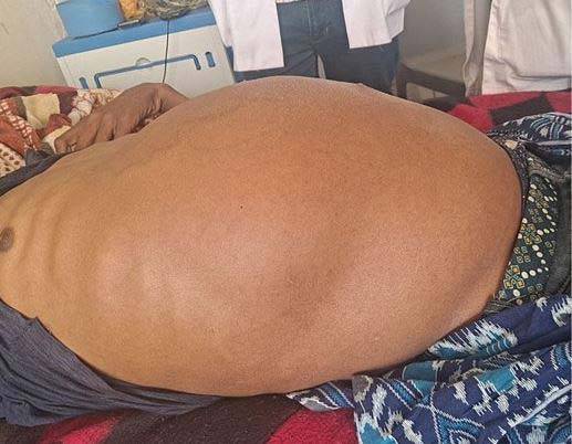 포충증 때문에 배가 부풀어 오른 에티오피아 20대 남성 모습./사진=Journal of Surgical Case Reports