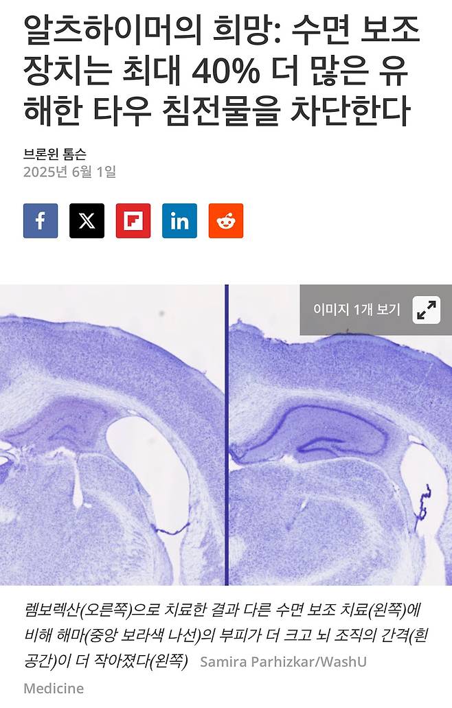 IMG_7660.jpeg 연구결과 불면증약은 치매 유해물질을 최대40% 차단함