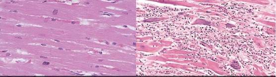 정상적인 심장 근육 세포(왼쪽)와 염증이 생긴 심근 세포(오른쪽). 사진 명지의원 심혈관센터.
