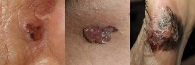 사진 왼쪽부터 원발성 피부암의 일종인 기저세포암, 편평세포암, 악성흑색종 병변 모습. 서울대병원 제공