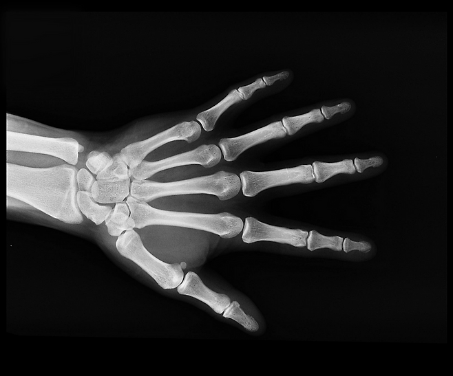 손 엑스레이 사진