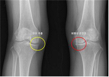 정상 무릎(노란색· 왼쪽)은 관절 간격이 잘 유지되고 뼈 모양이 정상이며, 퇴행성 관절염(빨간색 · 오른쪽)은 관절 간격이 좁아지고 뼈 모양이 변형됨