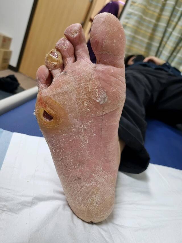 무심코 지나친 굳은살이 큰 문제로 진행할 수 있다|출처: 혜민병원