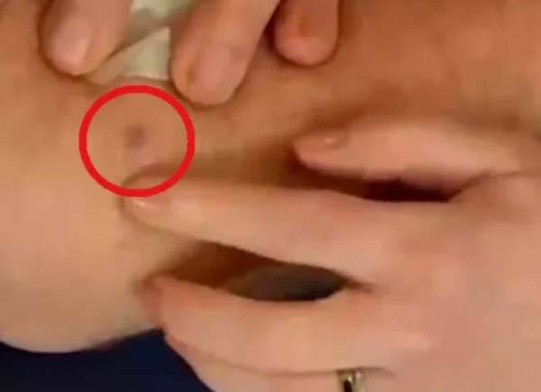 생방송 도중 발견된 마이크 제릭의 기저세포암(빨간색 동그라미)./사진=폭스뉴스