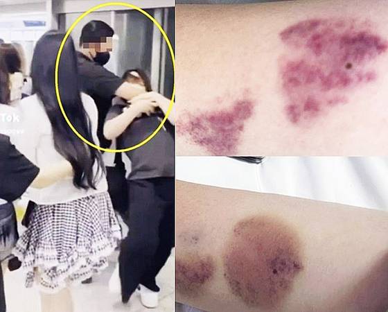 걸그룹 하츠투하츠 경호원이 공항에서 한 여성을 저지하고 있는 모습(왼쪽)과 이 여성이 공개한 폭행 피해 사진. 사진 틱톡·엑스 캡처