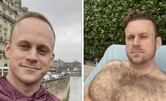 모발이식 전후 모습을 공개한 베넷. 인스타그램 캡처