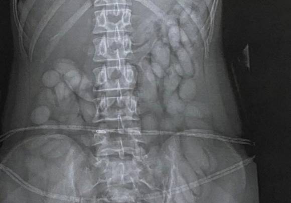 지난해 남아프리카공화국 요하네스버그 OR탐보 국제공항에서 뱃속에 마약을 넣어 운반한 나미비아 국적 30대 여성이 현지 경찰에 붙잡혔다. 남아프리카공화국 경찰 제공