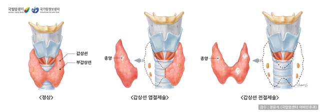 갑상선 절개수술 설명. 국립암센터 국가암정보센터
