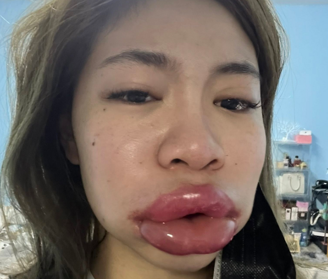 태국의 한 여성이 입술 필러 시술 후 히알루론산 알레르기 반응으로 입술과 얼굴이 심하게 부어올랐다. 그는 자신의 SNS에 부작용 사진을 공개하며, 시술 전 알레르기 검사의 중요성을 강조했다. (사진=SNS 캡처)
