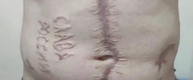 러시아에 포로로 잡혔던 우크라이나 군인의 몸에 남은 흉터. 사진=클레시리포트