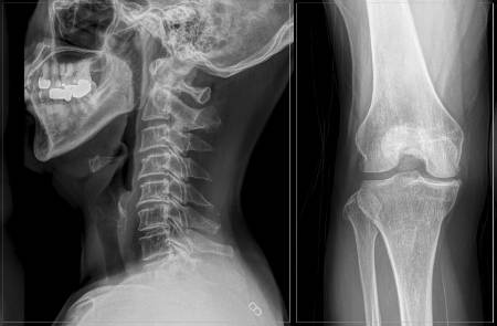 목, 무릎 등 척추·관절은 한 곳이 아프면 다른 곳도 따라 아프기 쉽다. 사진은 각 부위 X선 촬영 결과./사진=바른세상병원