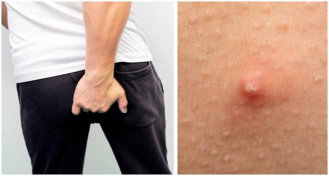 겨드랑이, 엉덩이 등에 주로 발병하는 희귀병 ‘화농성 한선염’ 환자가 매해 꾸준히 늘며 한 해 2만명 가까운 환자가 발생하고 있다. 게티이미지뱅크