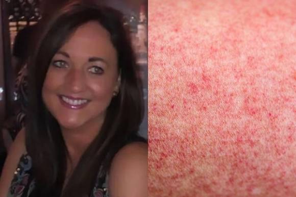 스페인으로 가족 여행을 떠난 40대 영국인 여성이 다수의 모기 물림 이후 건강이 급격히 악화하면서 어지럼증을 호소하다 호텔 계단에서 추락해 중태에 빠지는 일이 발생했다. 사진은 엠마 히키(왼쪽)와 모기 물림 관련 이미지. ‘고펀드미’(GoFundMe) 사이트 캡처 / 아이클릭아트