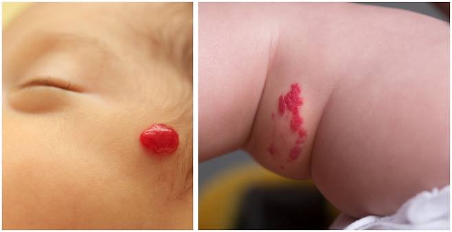 영유아 혈관종은 주로 얼굴이나 목에 생기며, 드물지만 몸이나 내부 장기에도 생길 수 있다. 게티이미지뱅크