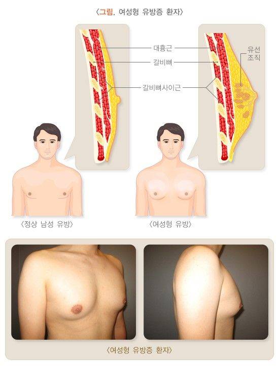 남성에게 에스트로겐이 과잉일 때 나타나는 증상은? [