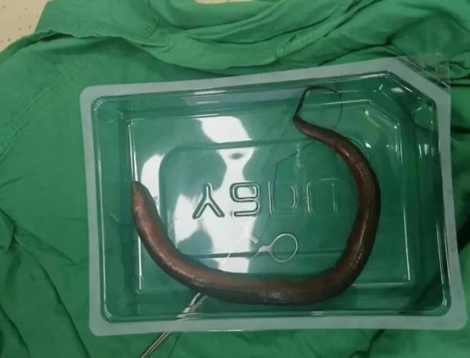 중국 남성의 뱃속에서 살아 있는 30㎝ 길이의 장어가 발견됐다. 화이화 데일리 캡처