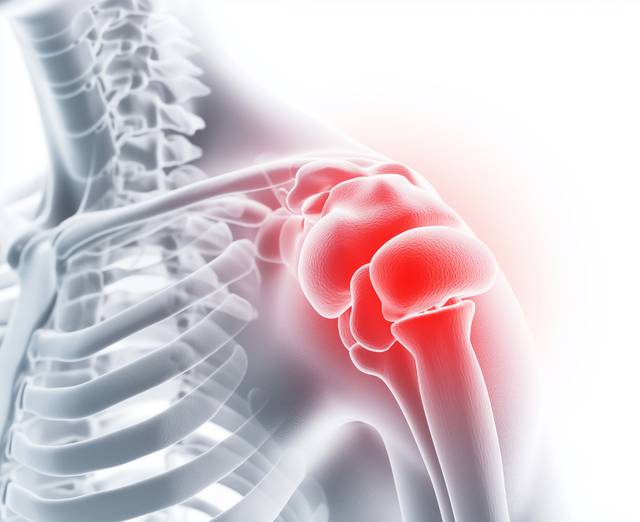 어깨를 자주 쓰는 운동이나 직업군에서 회전근개파열이 발생할 수 있어 주의가 요구된다. 사진은 기사의 특정 사실과 관련 없음 게티이미지뱅크
