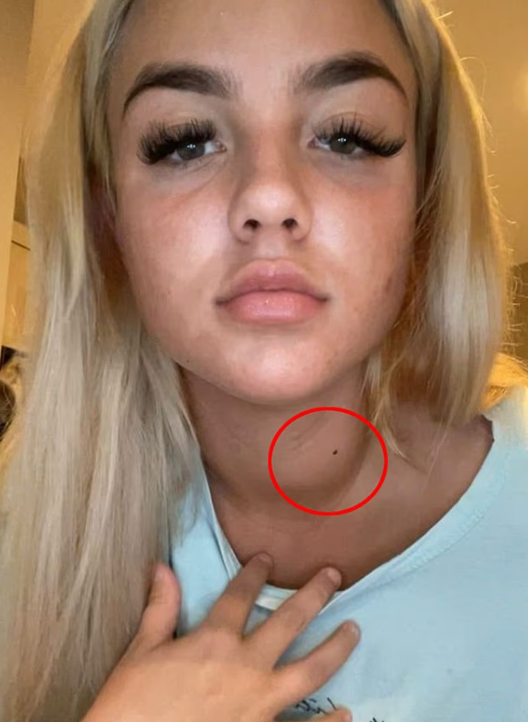 영국에서 한 20세 여성이 극심한 피로 등의 증상을 겪었으나 의사로부터 몇 년간 무시당한 뒤 갑상선암 판정을 받은 사연이 알려지며 경각심을 불러일으키고 있다. 틱톡 캡처