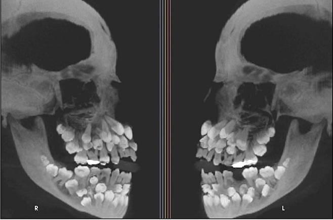 브라질의 한 소녀 입 안에서 치아 81개가 발견됐다./미국 치과교정·악안면외과학회지