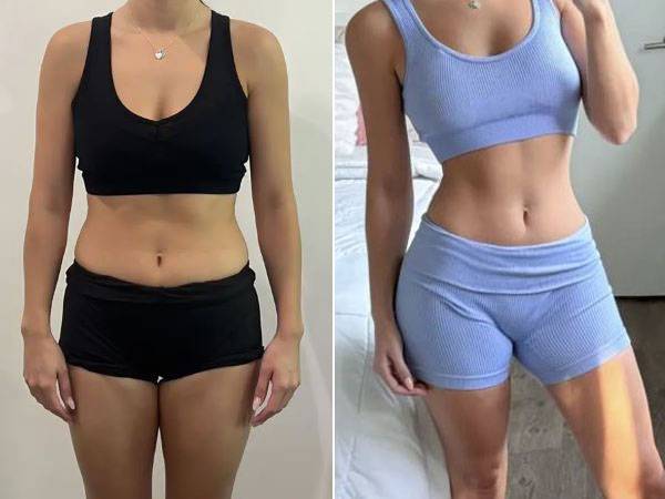 루이즈 로샤 레이테스가 카니보어 식단을 하기 전(왼)과 후(오)./사진=뉴욕포스트