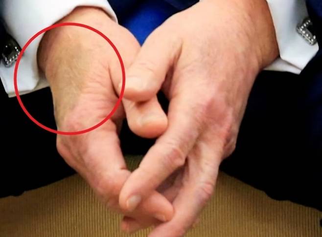 트럼프 미국 대통령의 손등에 선명한 푸른 멍. 로이터 연합뉴스