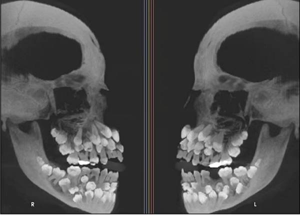 브라질 한 11세 소녀에게서 81개 치아가 발견돼 학계에 충격을 주고 있다. 사진은 11세 소녀 엑스레이. /사진=현지 매체 캡처